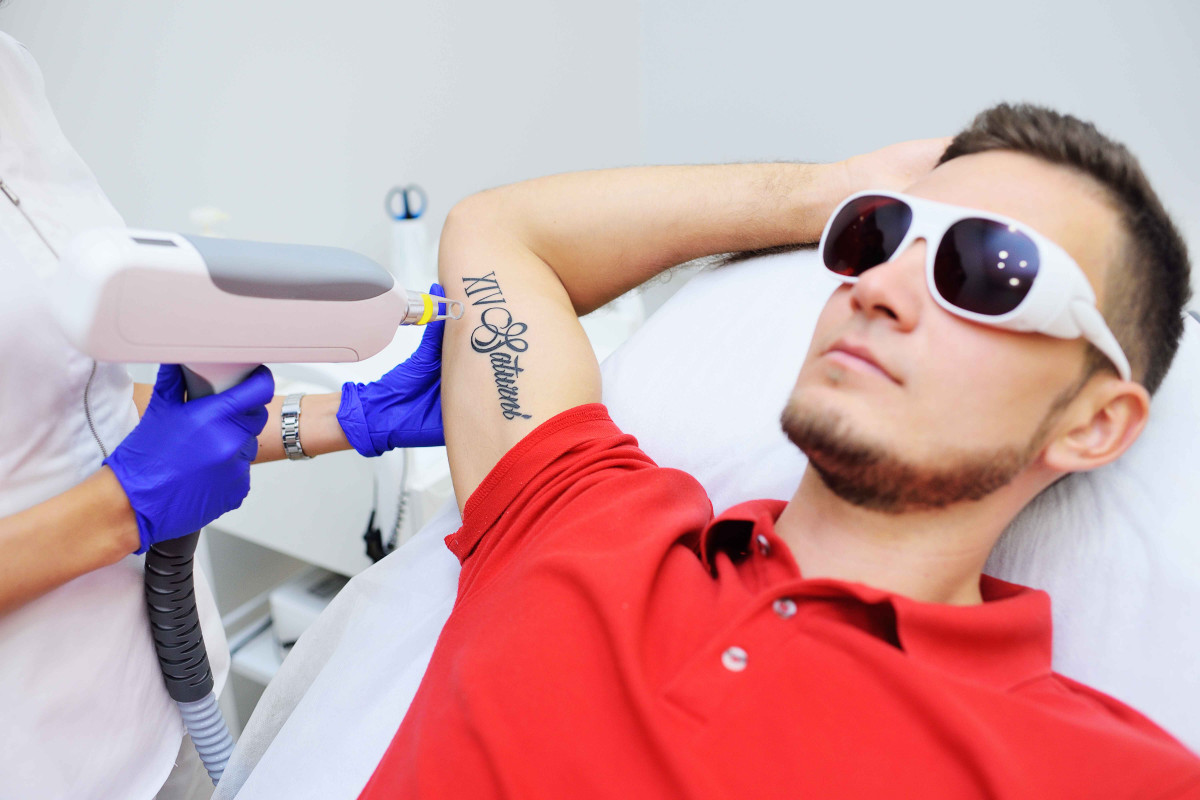 جلسة ازالة تاتو